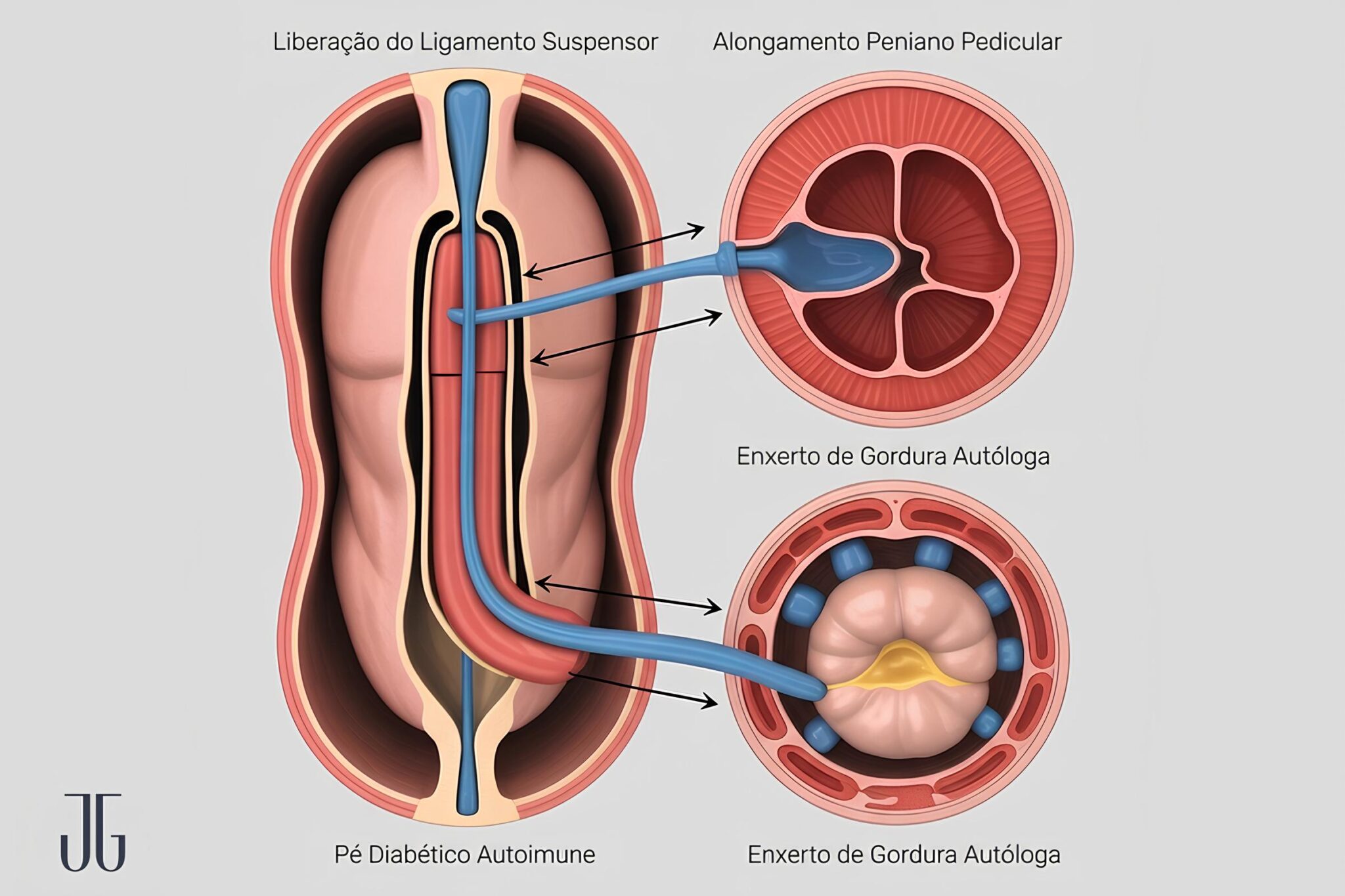 Faloplastia: O que é, tipos, como é feita, indicações e preços
