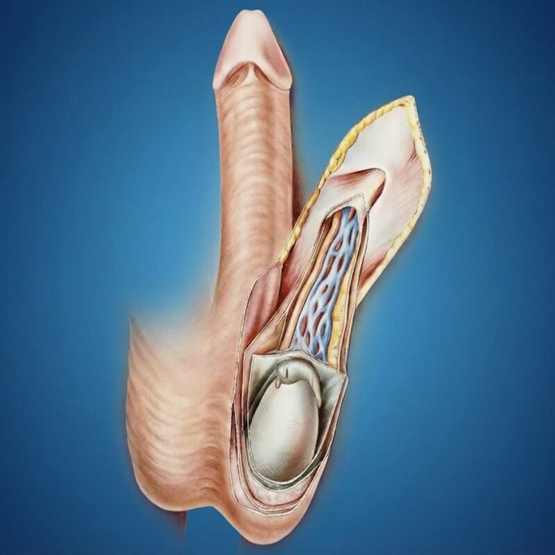 Como reverter a doença de Peyronie