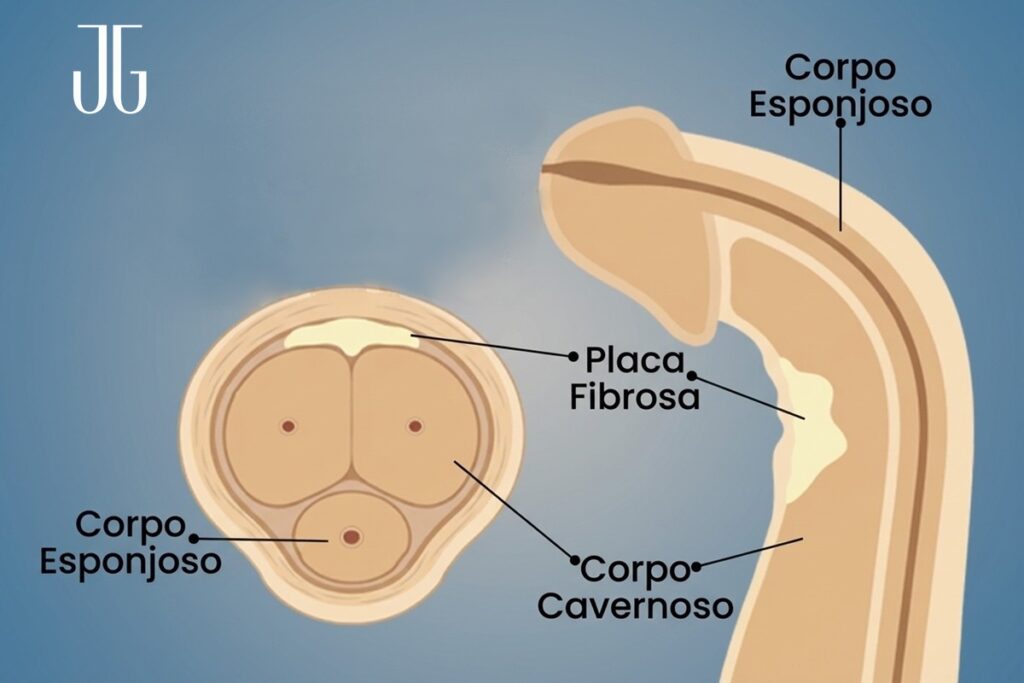 Doença de Peyronie Tem Cura