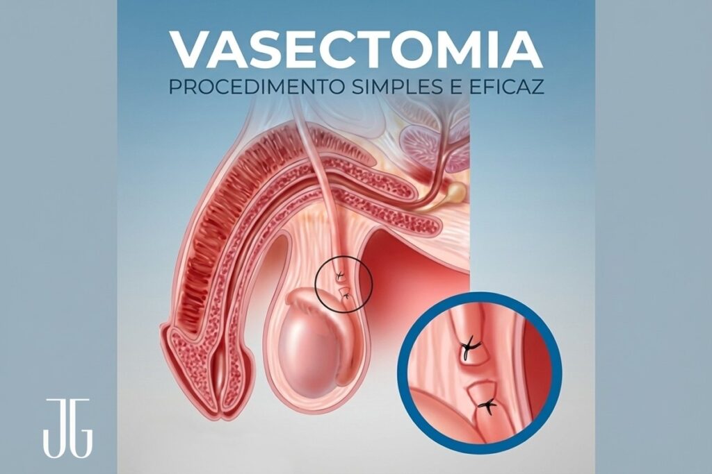 Tipos de vasectomia
