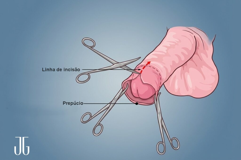 como é a cirurgia de fimose