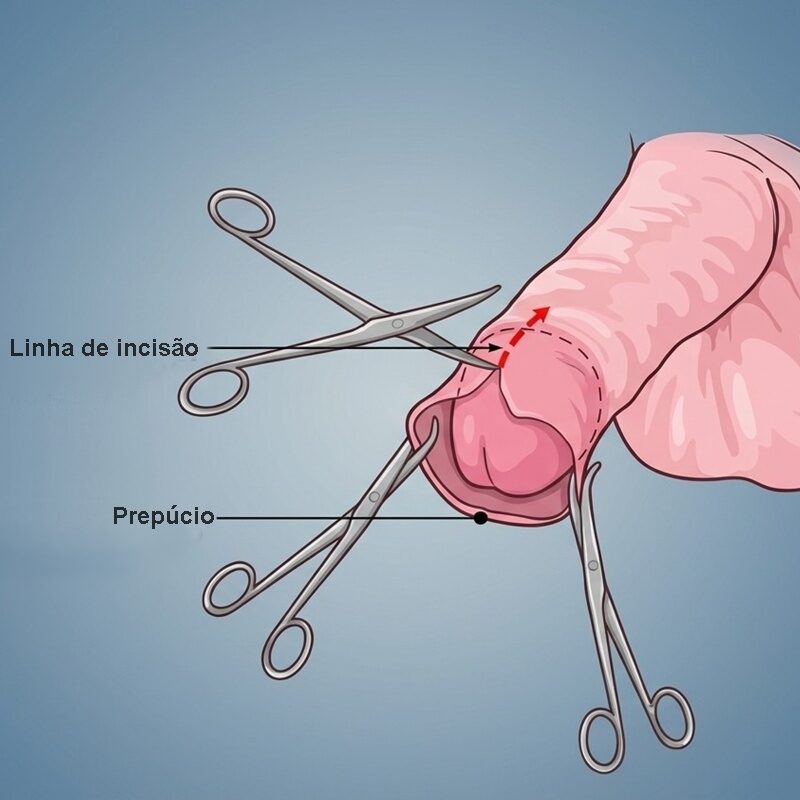 como é a cirurgia de fimose
