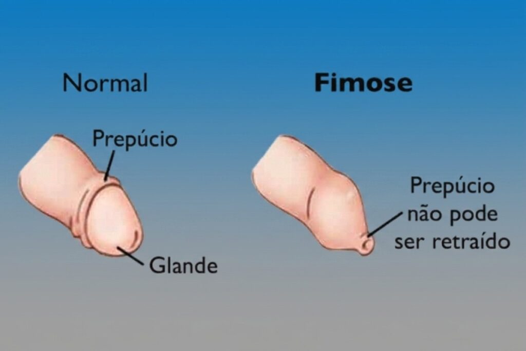 Qual o valor da cirurgia para tirar fimose