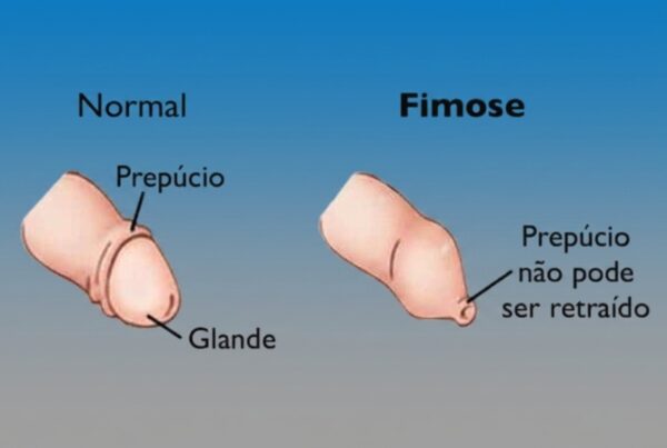 Qual o valor da cirurgia para tirar fimose