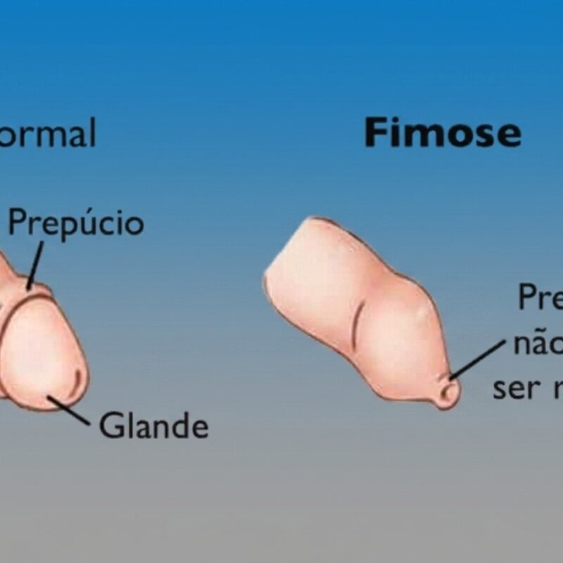 Qual o valor da cirurgia para tirar fimose