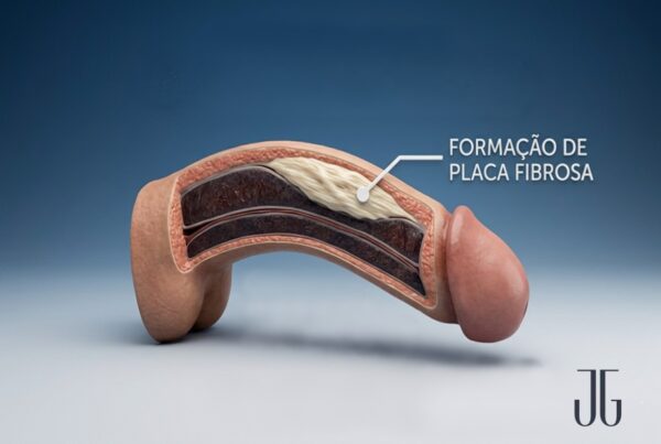 fibrose peniana