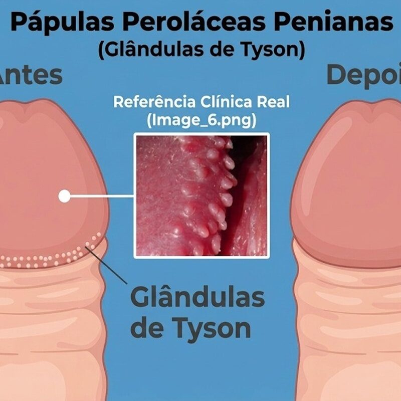 O que são as glândulas de Tyson